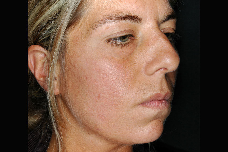 laser cicatrici acne post 1 anno pre 2 trattamento