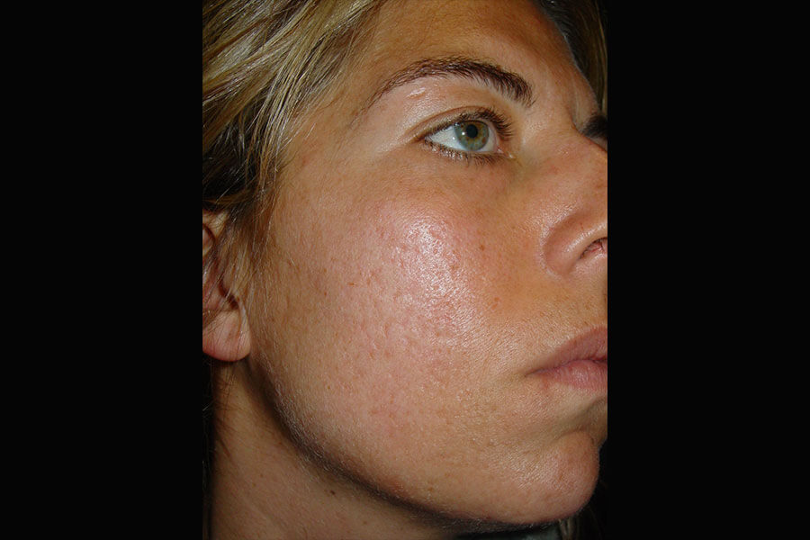 laser cicatrici acne pre