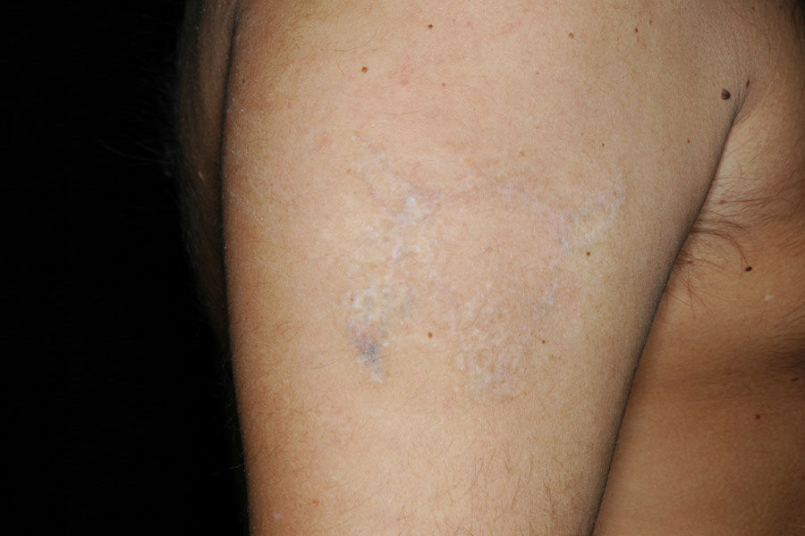 Laser rimozione tatuaggi post 10 trattamenti